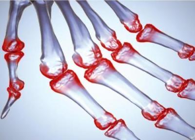 ورم مفصل یا آرتریت چیست و چه عللی دارد؟ ورم مفصل یا آرتریت چیست و چه عللی دارد؟