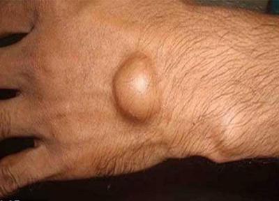 تومور های خوش خیم غیرسرطانی پوستی چیست؟ تومور های خوش خیم غیرسرطانی پوستی چیست؟